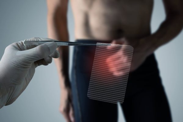 A man presents with abdominal pain from a hernia as a surgeon presents surgical mesh to treat the condition.